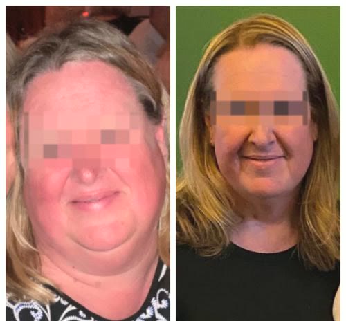 Before and after, a Qua weight loss patient