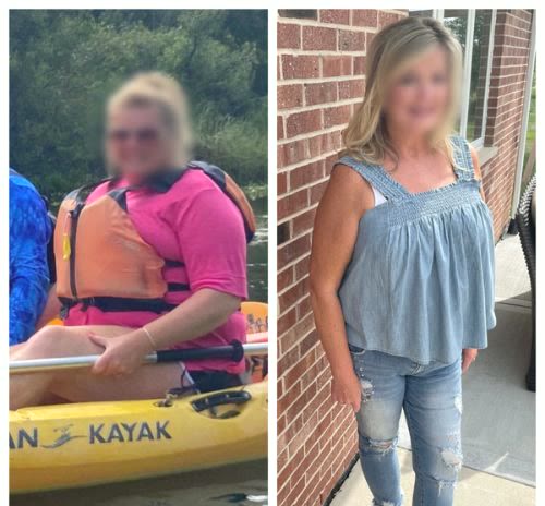 Before and after, a Qua weight loss patient