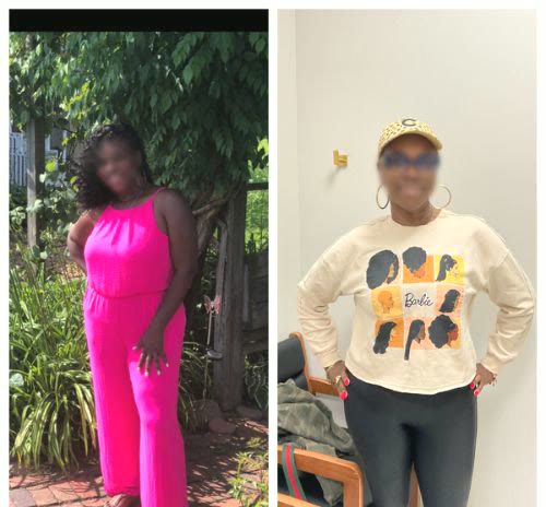 Before and after, a Qua weight loss patient